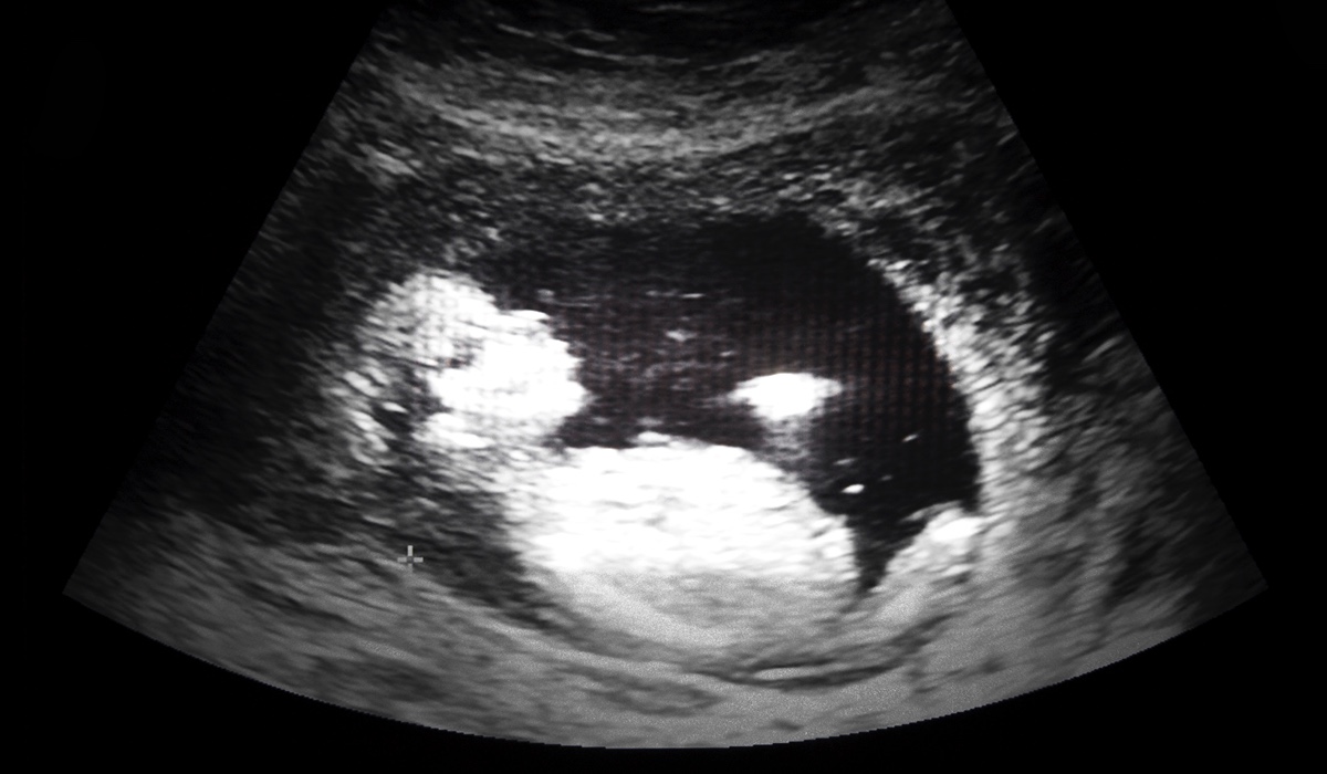 baby in an ultrasound